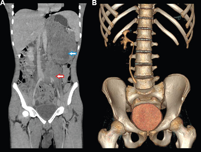 (A) Contrast enhanced computed tomography of abdomen showing a left renal mass replacing the whole kidney (blue arrow) with retroperitoneal lymphadenopathy encasing left iliac vessels and abdominal aorta (red arrow) and (B) non-functioning left kidney on CT intravenous urography.